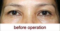 plastic-surgery-blepharoplasty